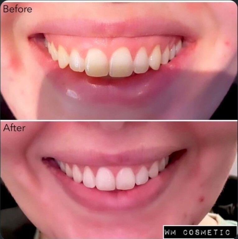 Before and after result following gummy smile treatment