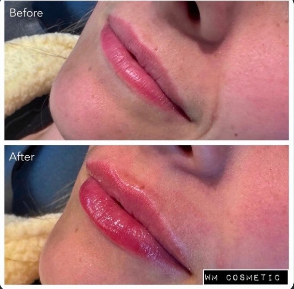 Before and after result following first-time Belotero Lips treatment