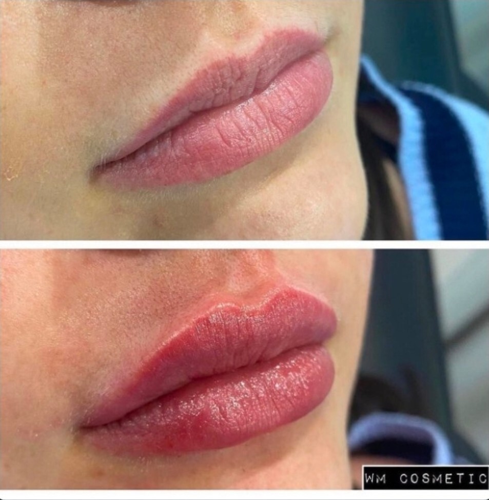 Before and after result following Belotero lip treatment