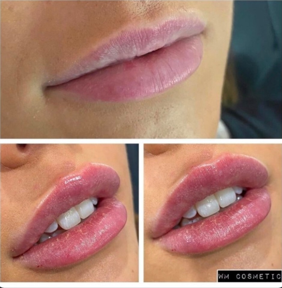 Before and after result following Belotero lip treatment