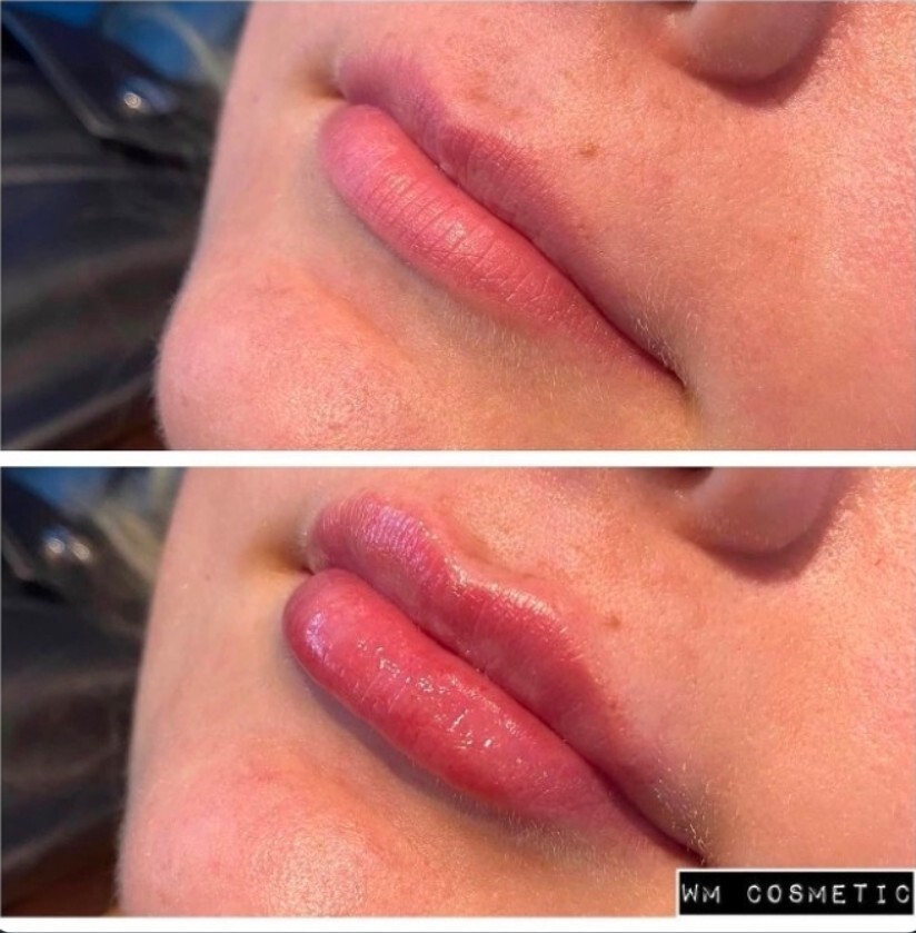 Before and after result following Belotero lip treatment