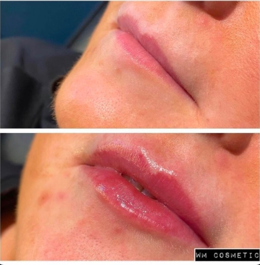 Before and after result following Belotero lip augmentation