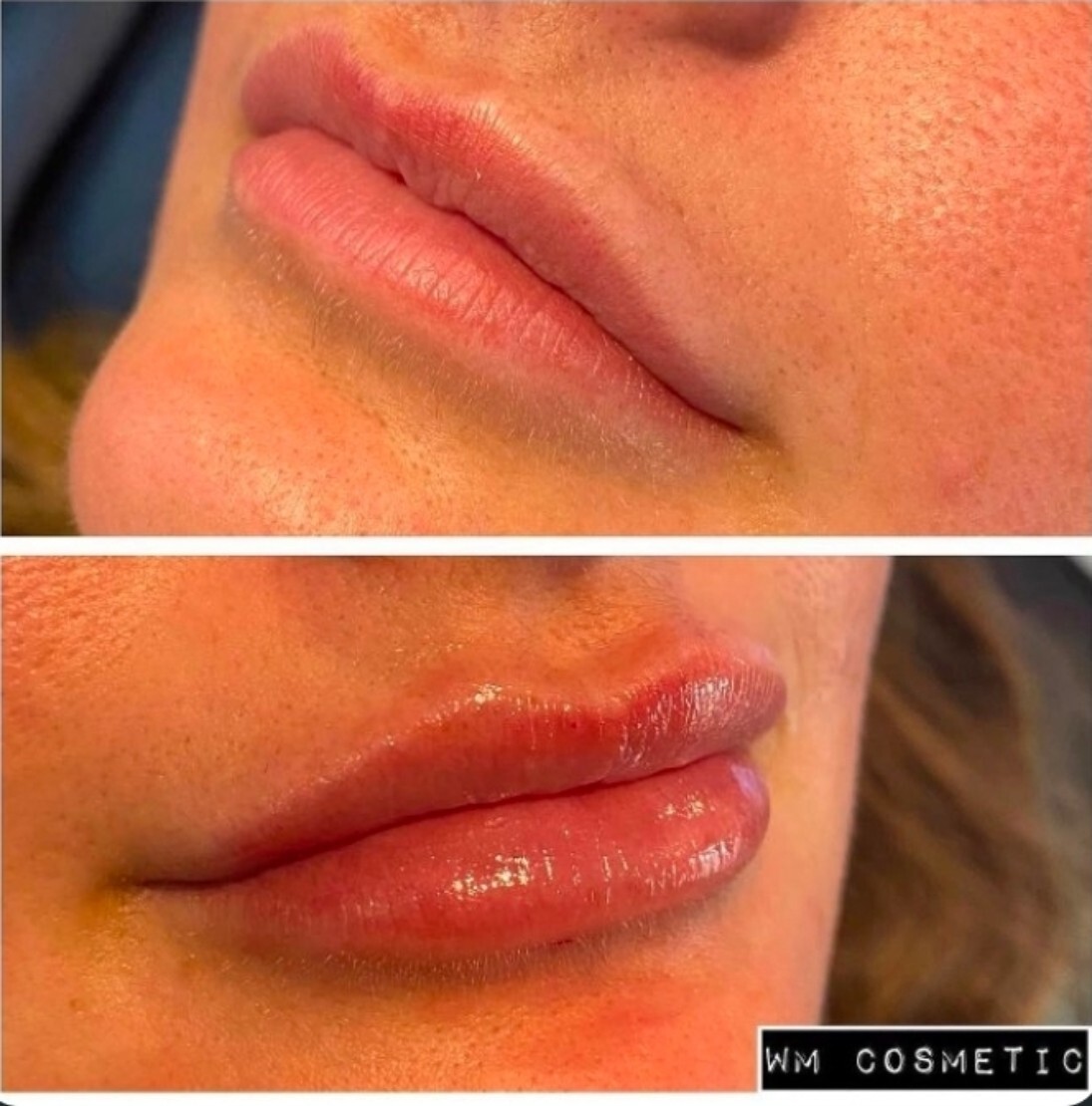 Before and after result following Belotero lip augmentation