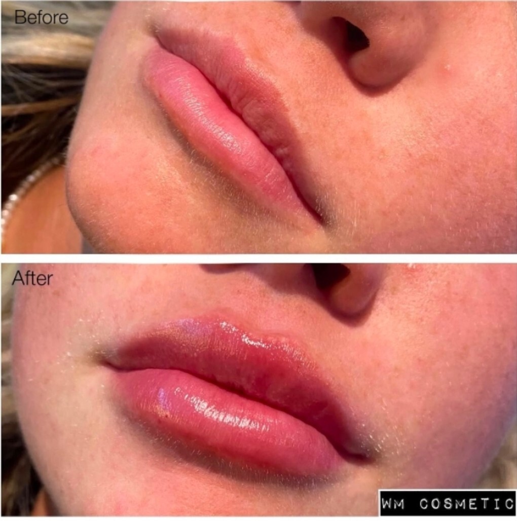 Before and after result showing enhanced lip border and volume