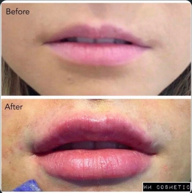 Before and after lip augmentation maintaining the Cupid's bow