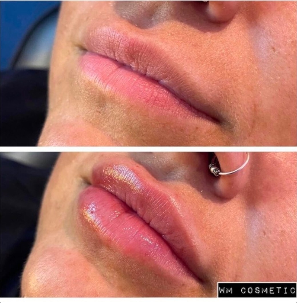 Before and after result following lip augmentation
