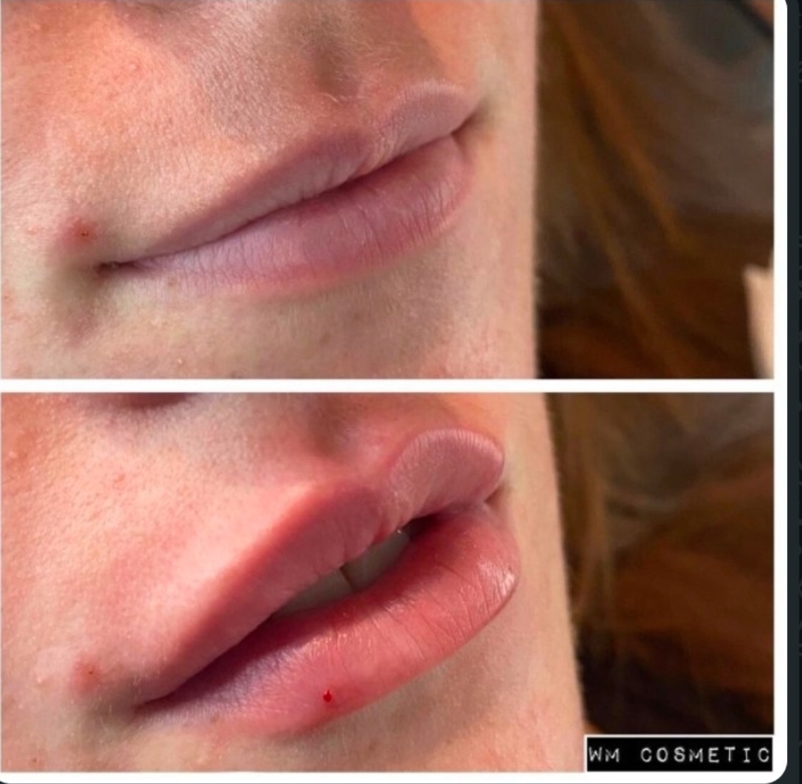 Before and after result following lip definition treatment