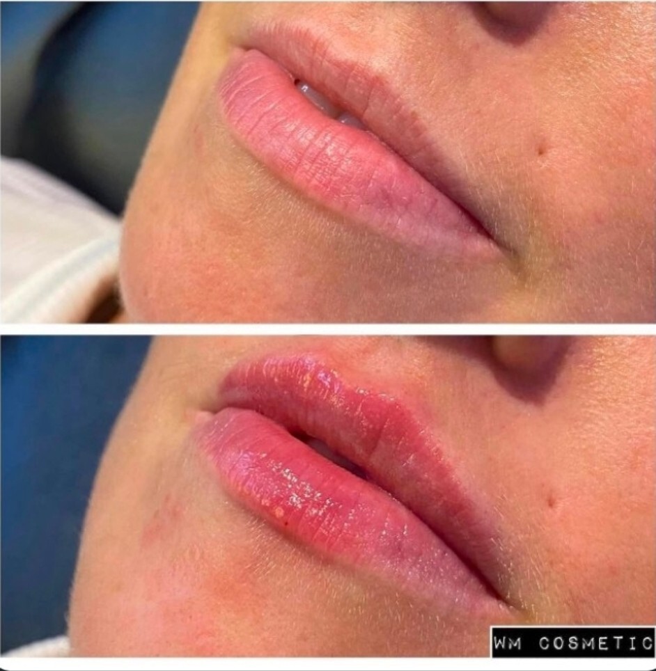 Before and after result following first-time 0.5ml lip augmentation