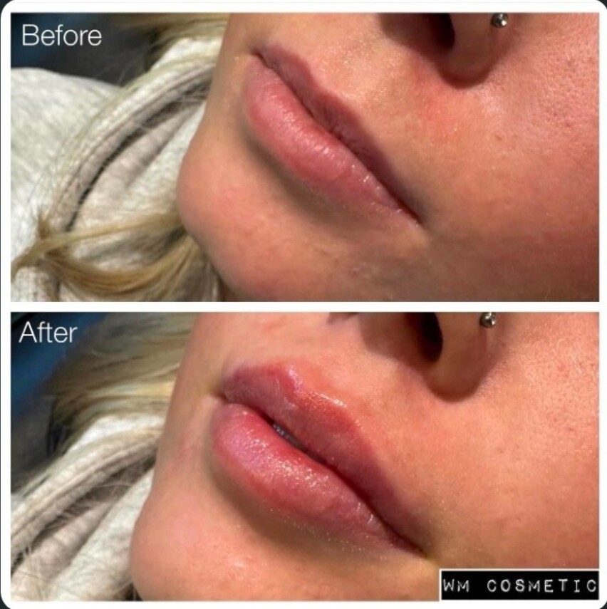 Before and after result following first-time 0.5ml lip filler