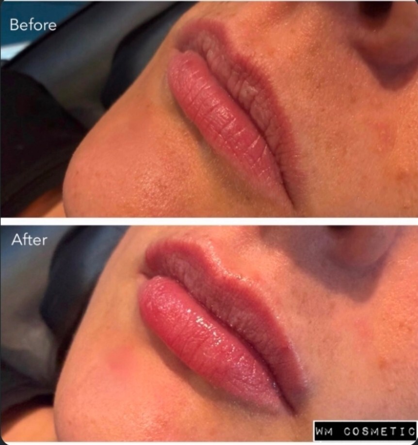 Before and after result following first-time 1ml lip augmentation