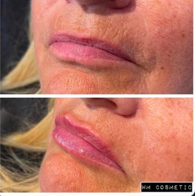 Before and after result following natural lip enhancement
