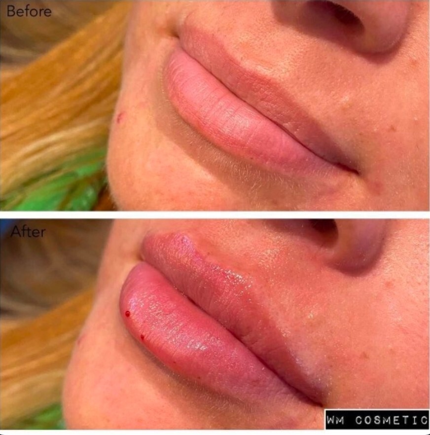 Before and after result following Restylane Kysse lip augmentation