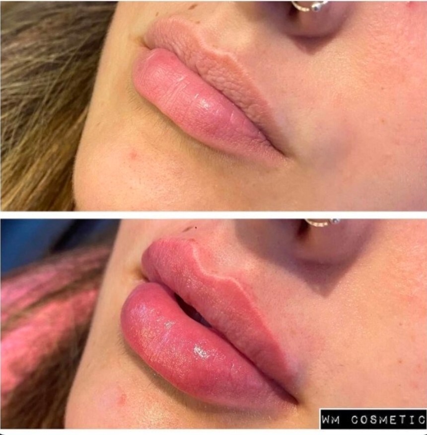 Before and after result following Restylane Kysse lip augmentation