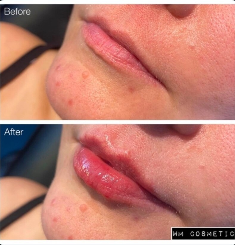 Before and after result following Teosyal RHA Kiss lip augmentation