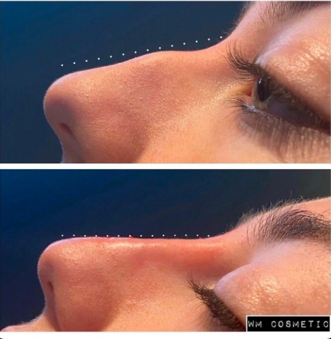 Before and after result following Teosyal RHA Kiss lip augmentation
