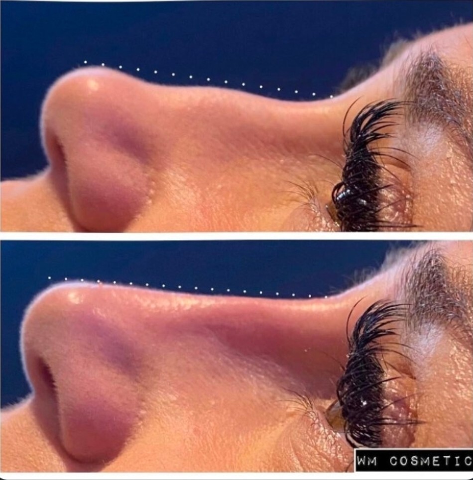Before and after result following lip augmentation