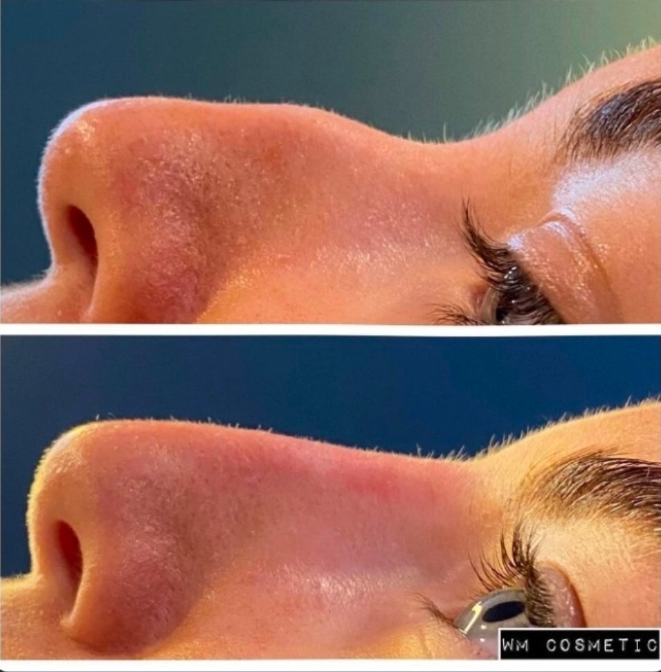 Before and after result following liquid rhinoplasty