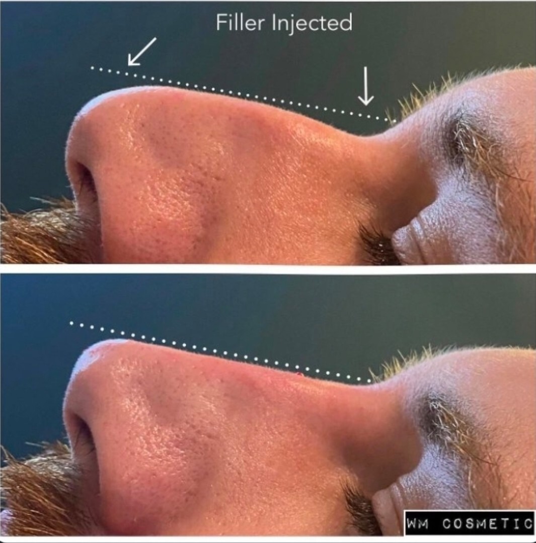 Before and after result following deep filler liquid rhinoplasty