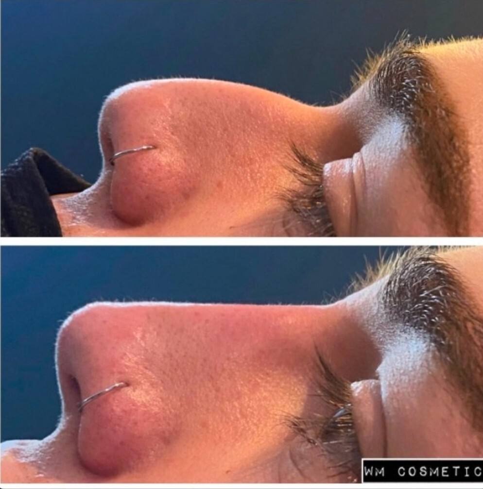 Before and after result following liquid rhinoplasty