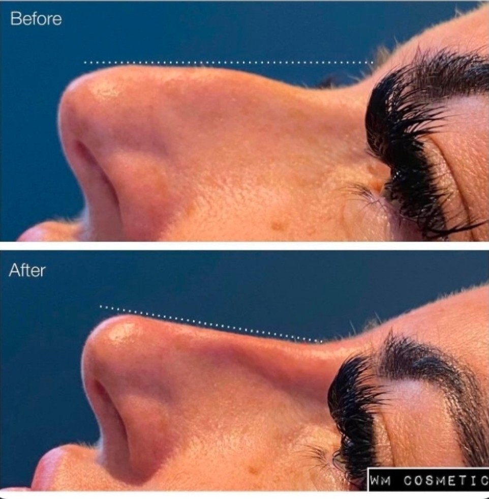 Before and after result following liquid rhinoplasty