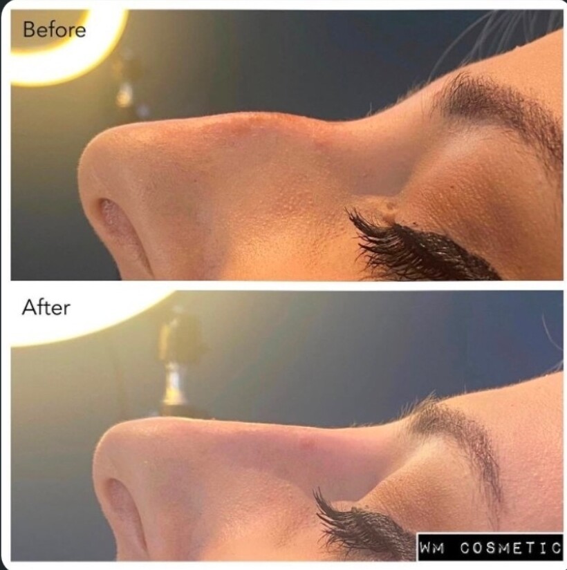 Before and after profile following liquid rhinoplasty