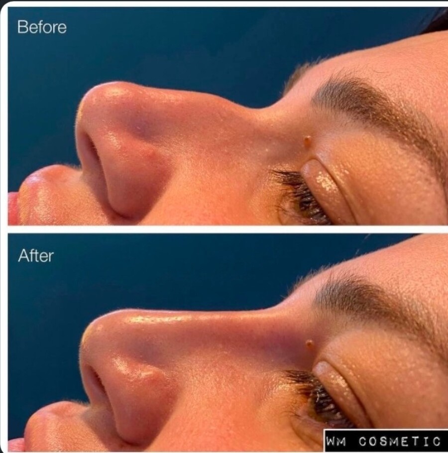 Before and after result following non-surgical rhinoplasty