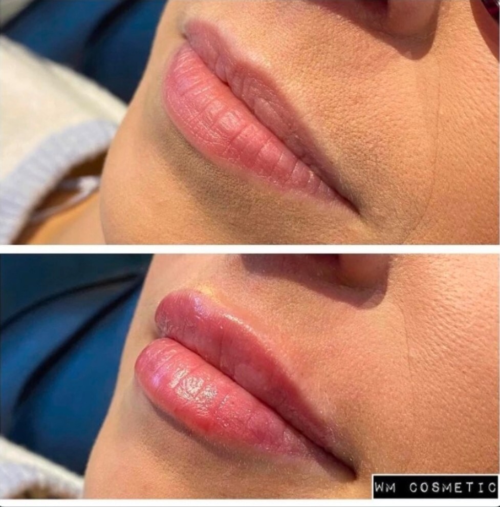 Before and after result following liquid rhinoplasty